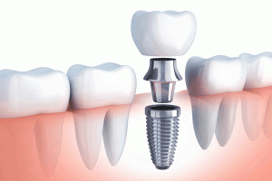 Implantes dentales en Zaragoza