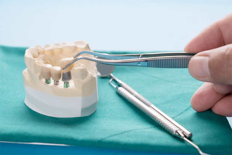 Implante dental en Zaragoza