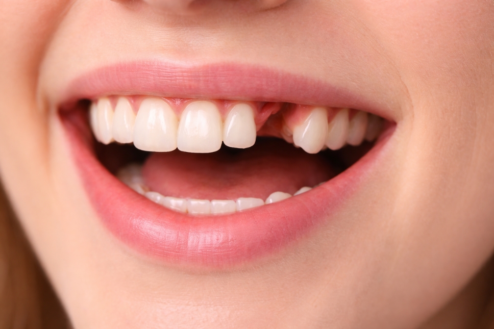 Chica sonriendo con diente faltante