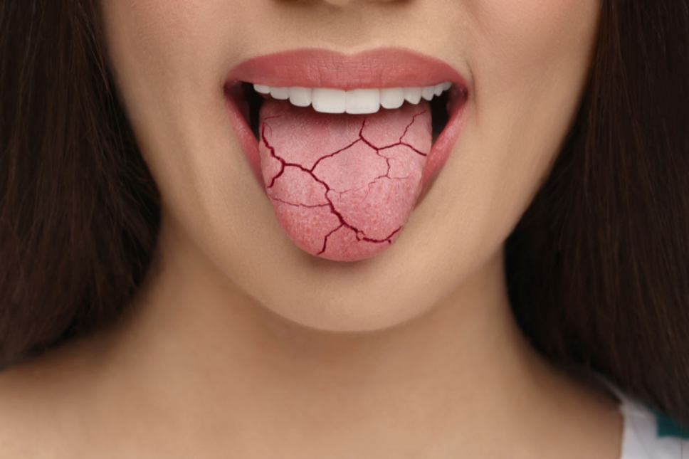 Mujer con xerostomía enseñando su lengua