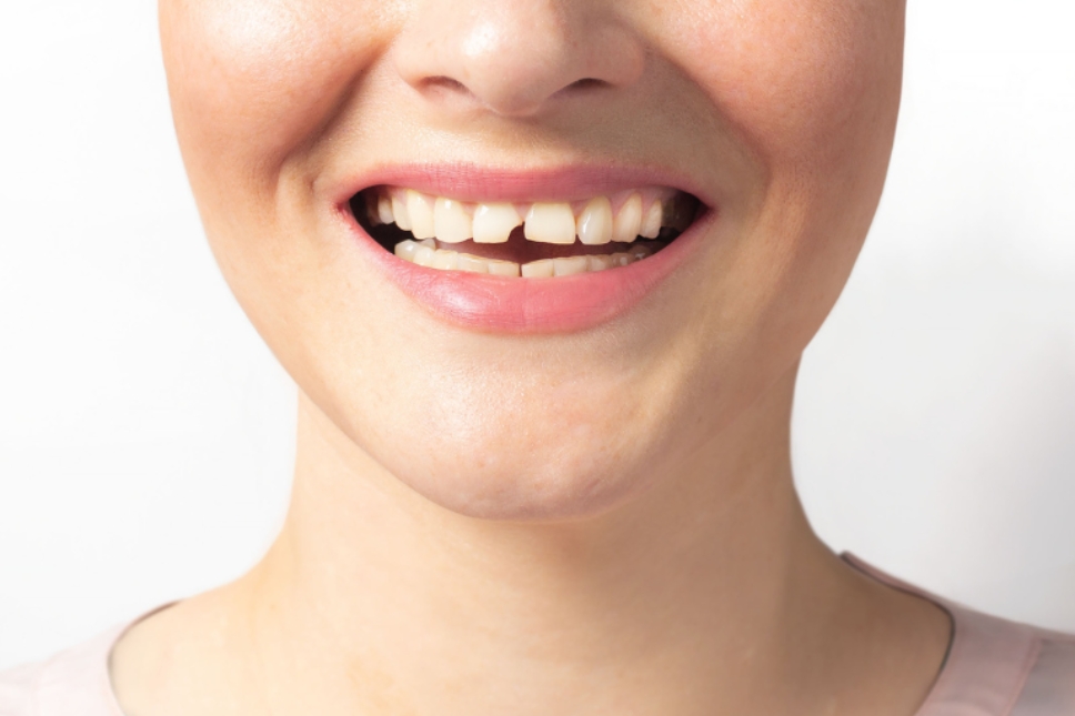 Mujer sonriendo con diente fracturado