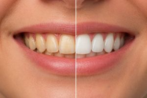 Sonrisa antes y después de tomar café