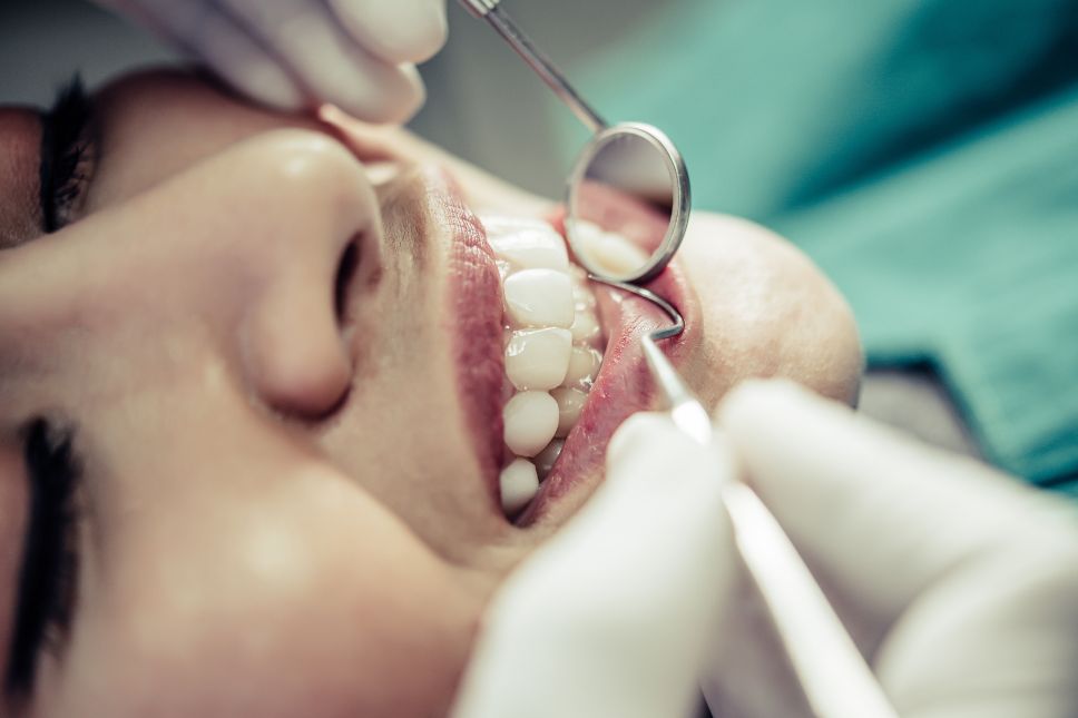 ¿Qué es una corona dental Tipos y cuándo se necesita