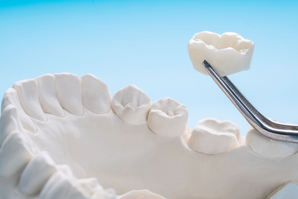 Qué es una corona dental